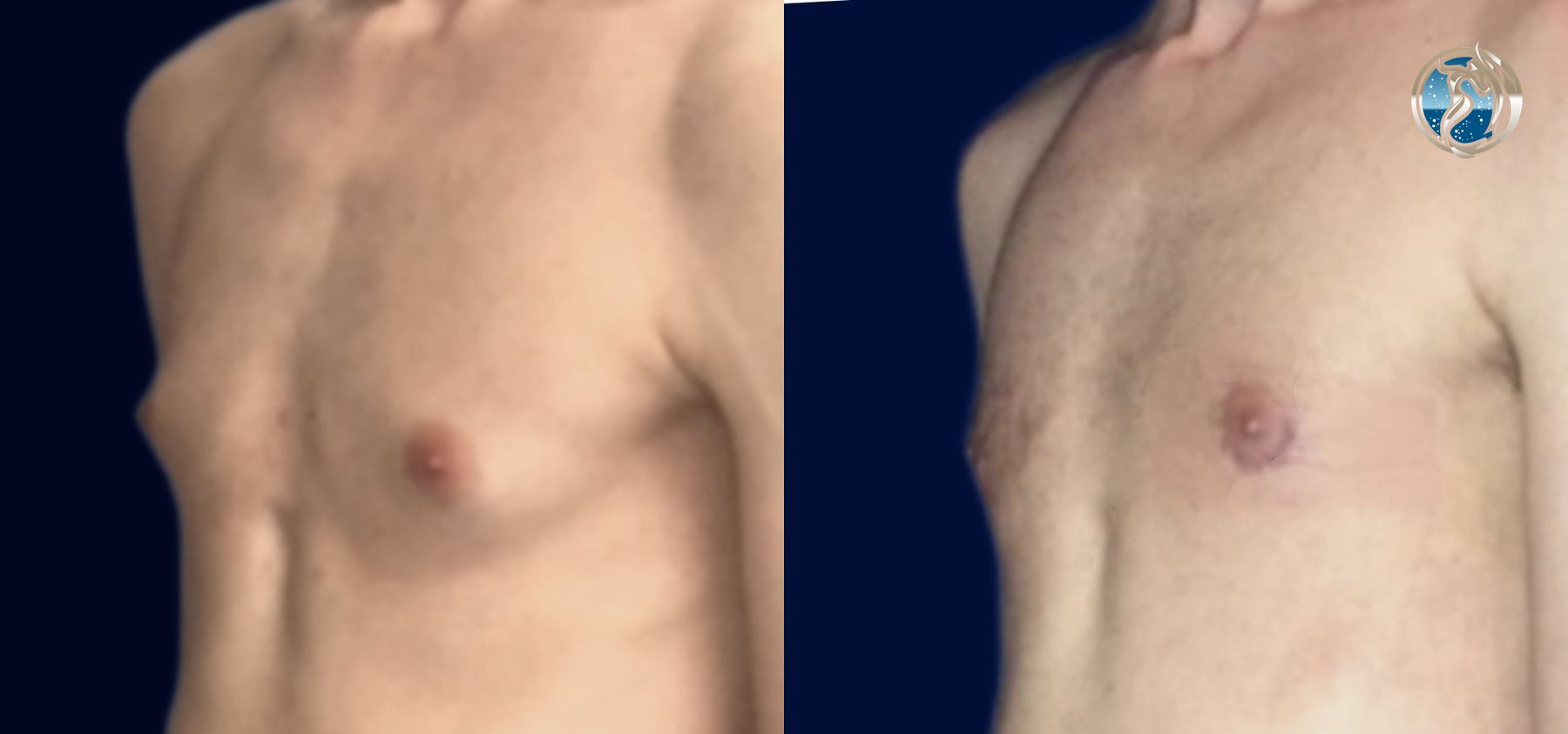 Before and after Gynecomastia case 46089 - Angle 4
