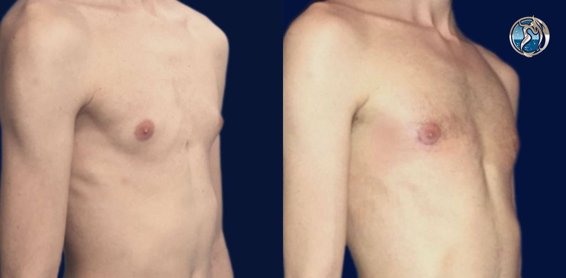 Before and after Gynecomastia case 46089 - Angle 2