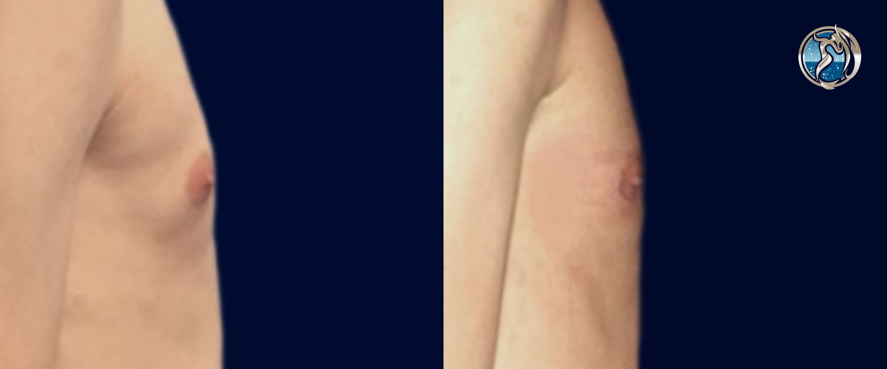 Before and after Gynecomastia case 46089 - Angle 3