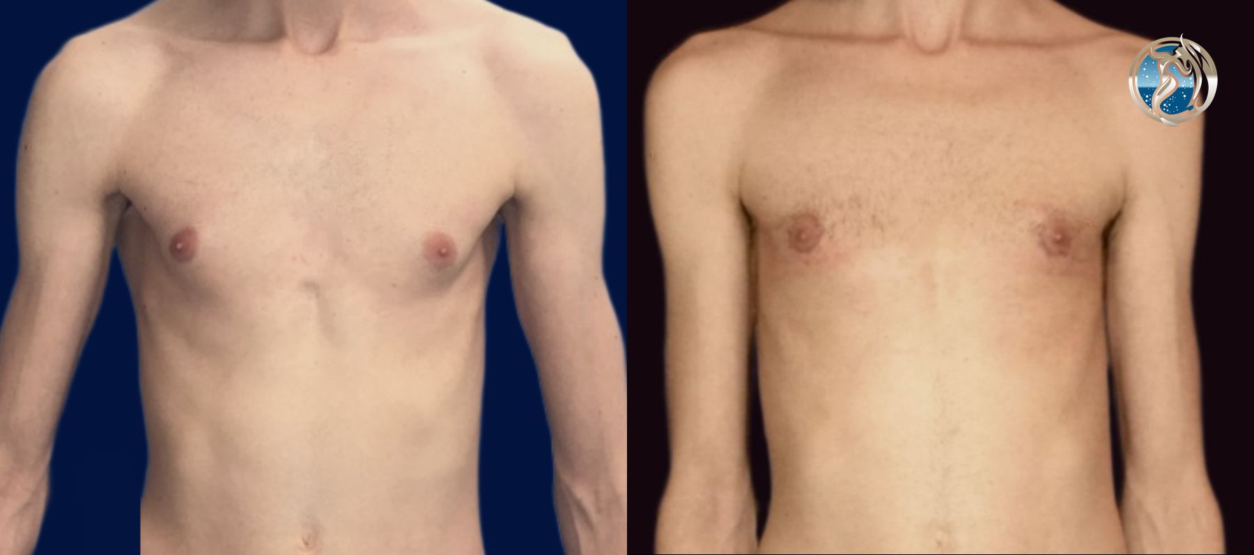 Before and after Gynecomastia case 46089