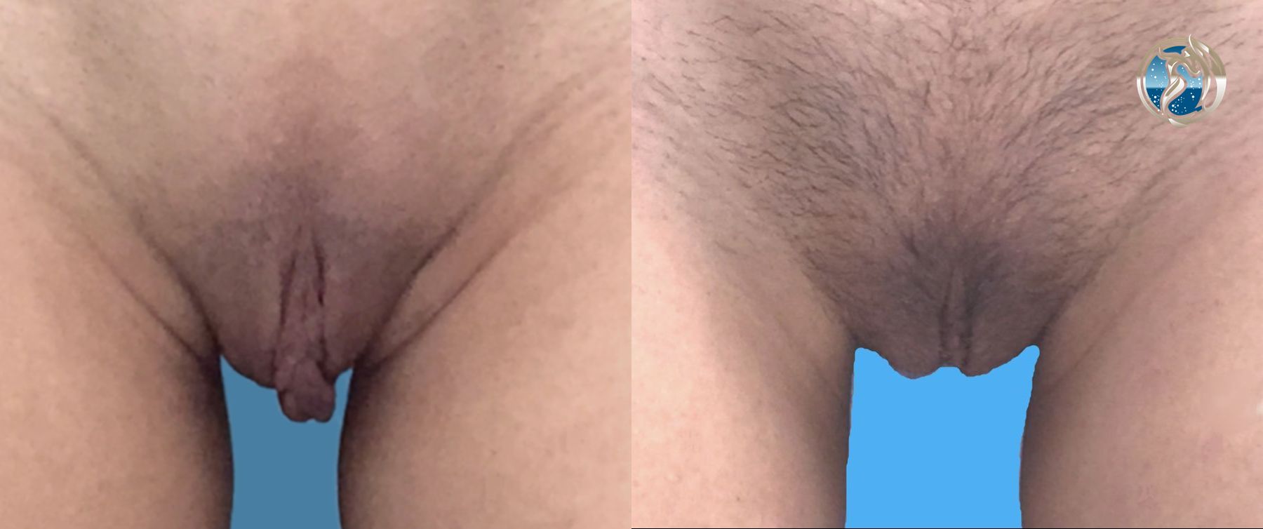 Before and after Labiaplasty +/-clitoral hood reduction case 46045