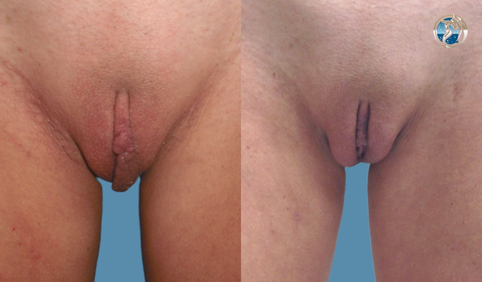 Before and after photo of labiaplasty vaginal rejuvenation by Dr. Orna Fisher in San Mateo, CA