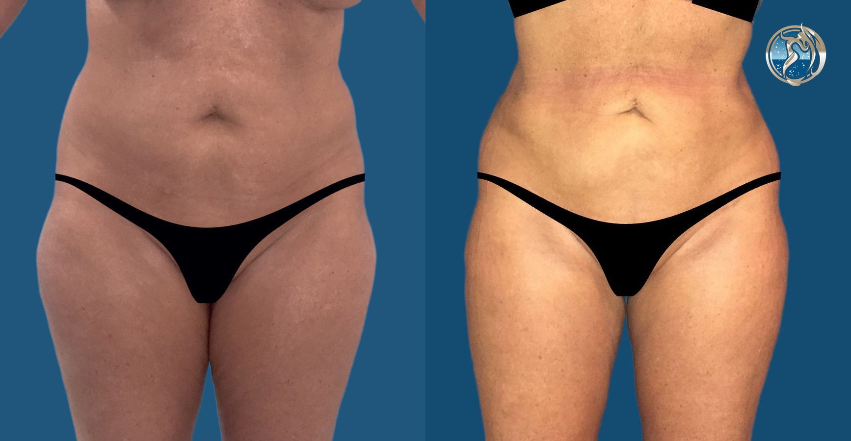 Before and after photo of Liposculpting by Dr. Orna Fisher in San Mateo, CA