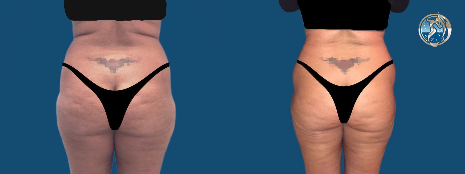 Before and after photo of Liposculpting by Dr. Orna Fisher in San Mateo, CA - Angle 2