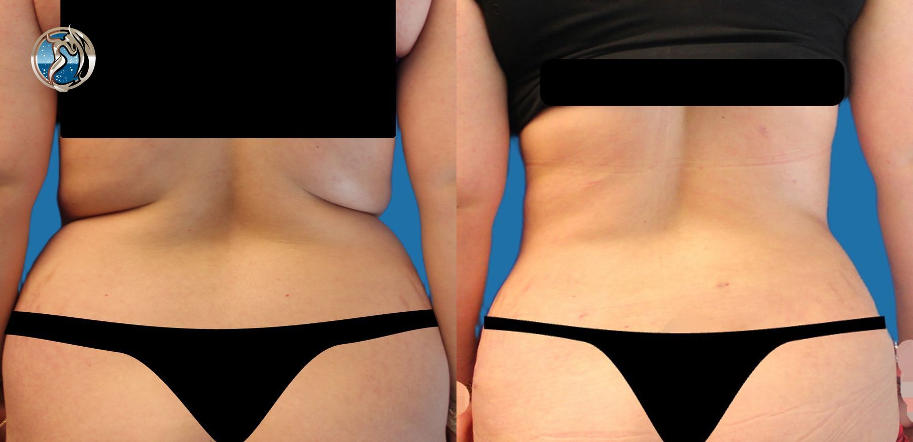 Before and after Liposuction and BodyTite minimally invasive surgical tightening case 43748