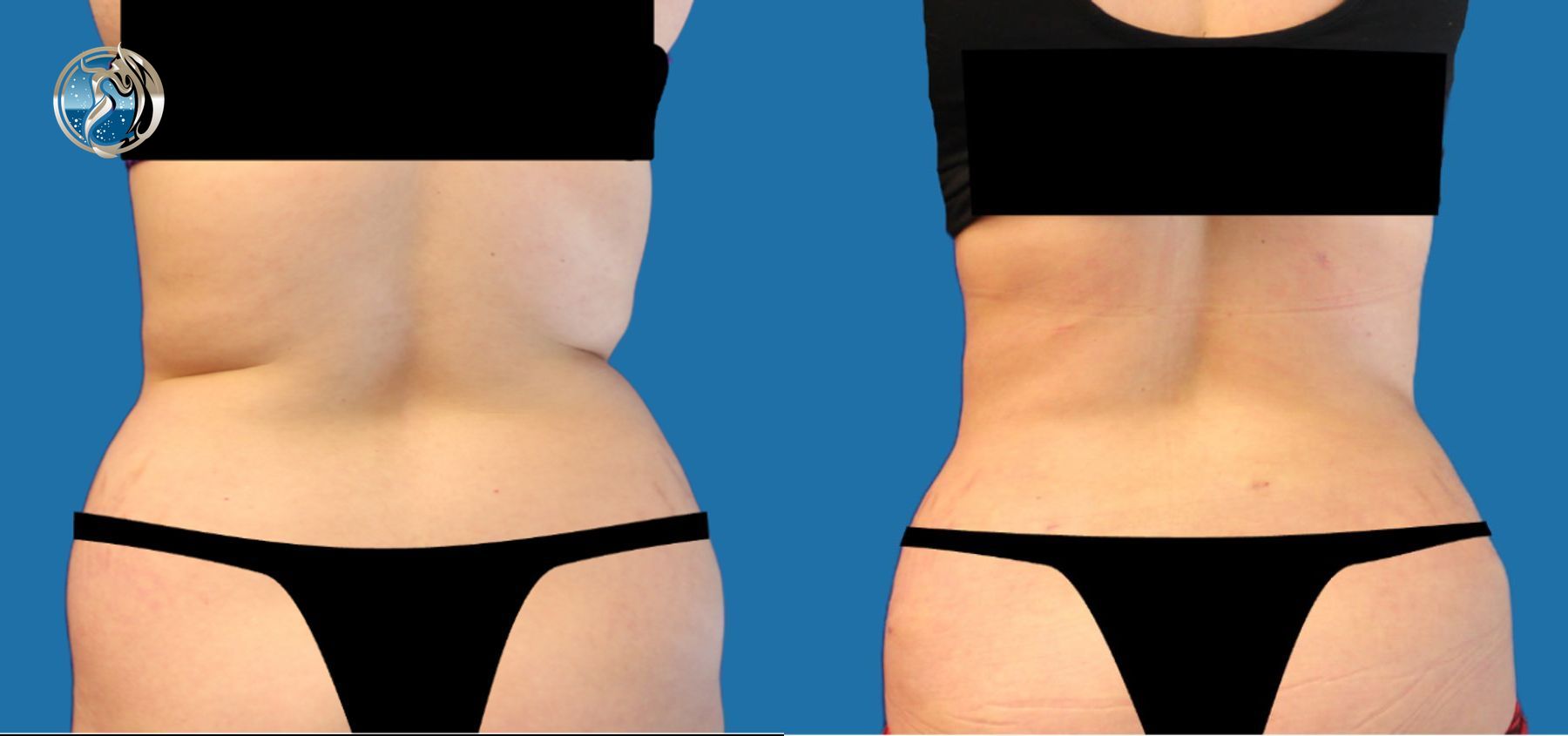 Before and after Liposuction and BodyTite minimally invasive surgical tightening case 43748 - Angle 2