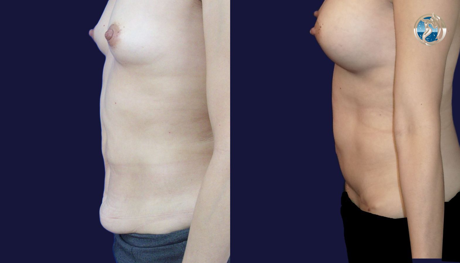 Before and after Combined Abdominal and Breast rejuvenation case 43774 - Angle 3