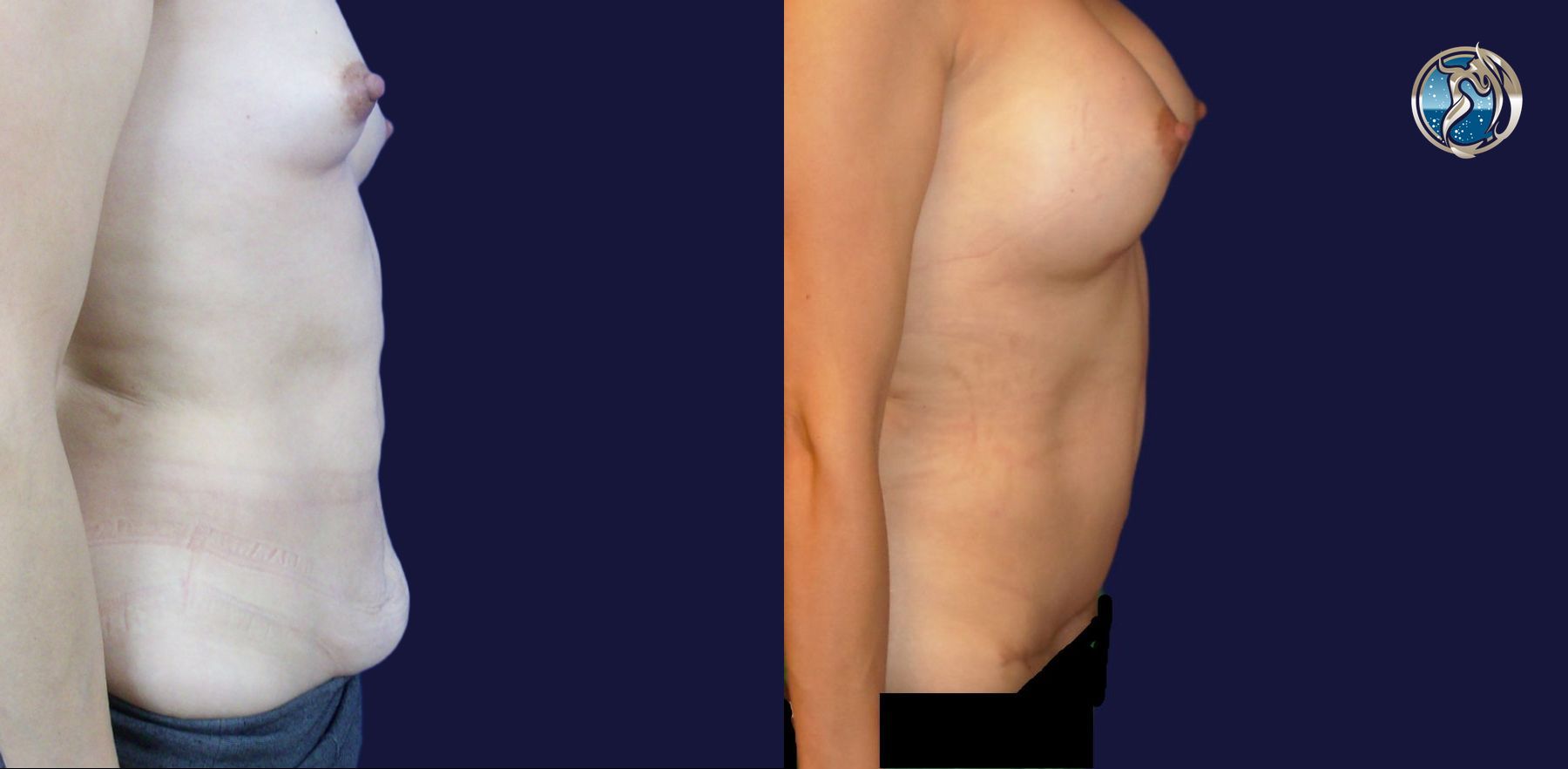 Before and after Combined Abdominal and Breast rejuvenation case 43774 - Angle 2