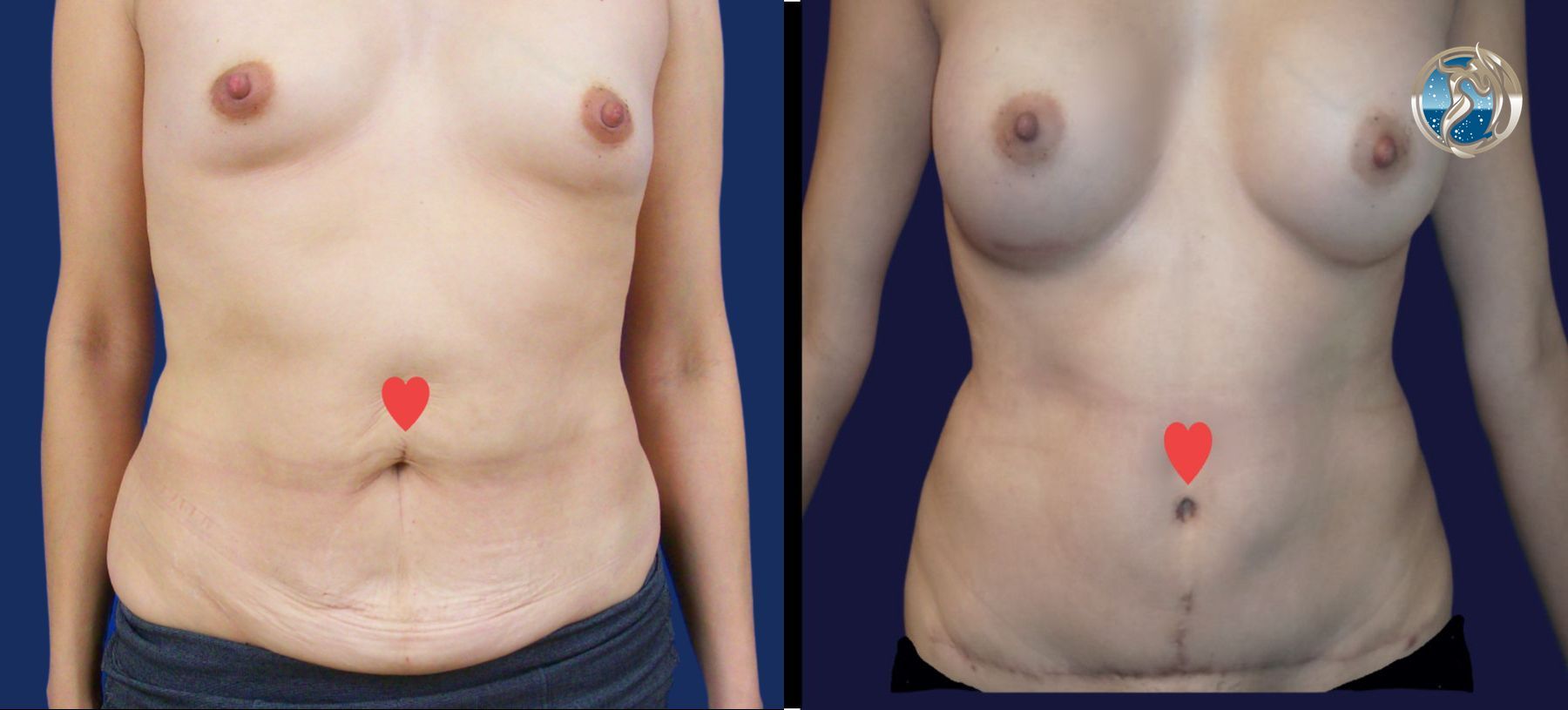 Before and after Combined Abdominal and Breast rejuvenation case 43774