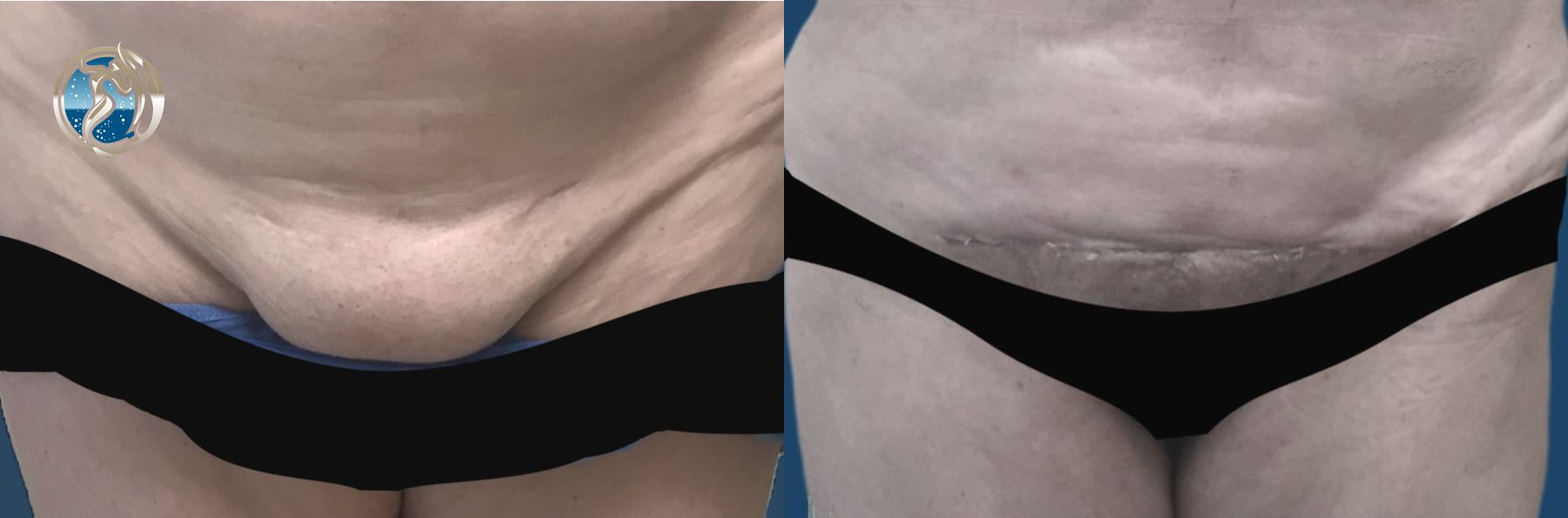 Before and after Monsplasty case 46042