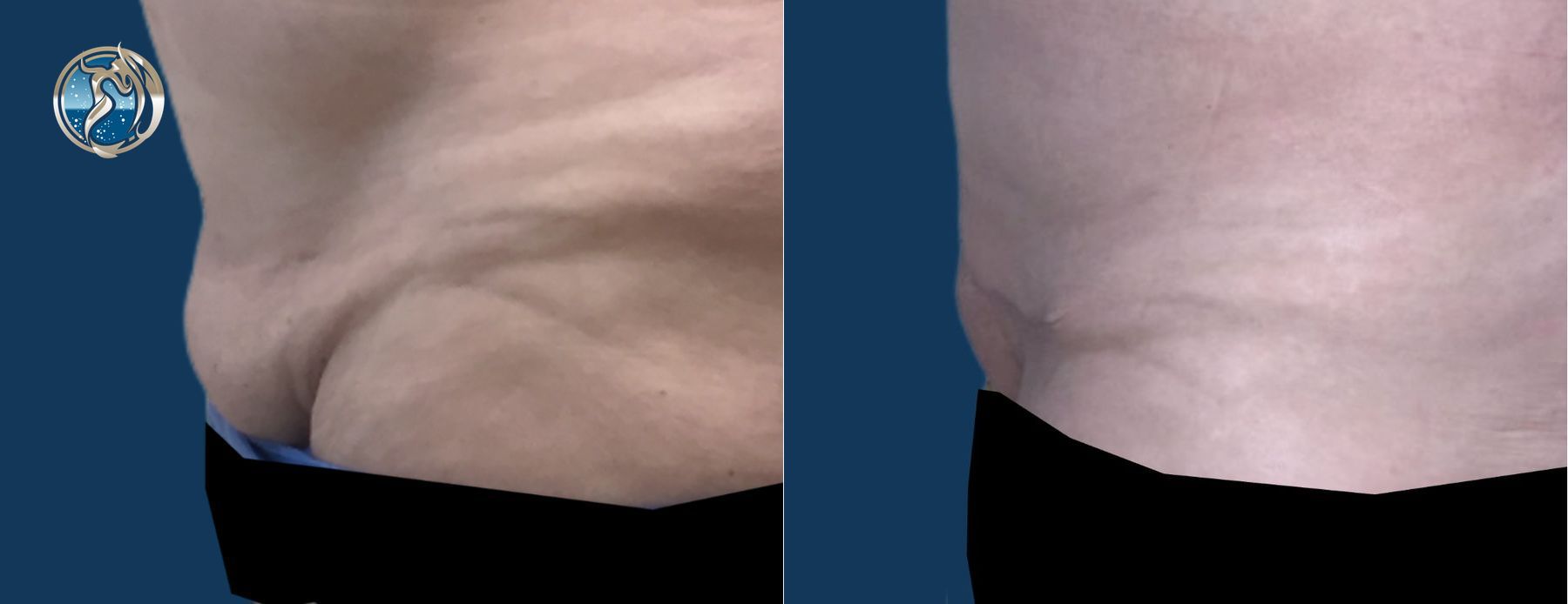 Before and after Monsplasty case 46042 - Angle 3