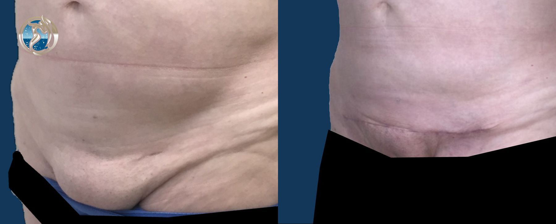 Before and after Monsplasty case 46042 - Angle 2