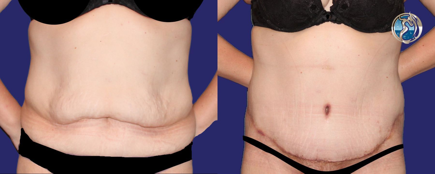 Before and after photo set body contouring by Dr. Orna Fisher in San Mateo, CA
