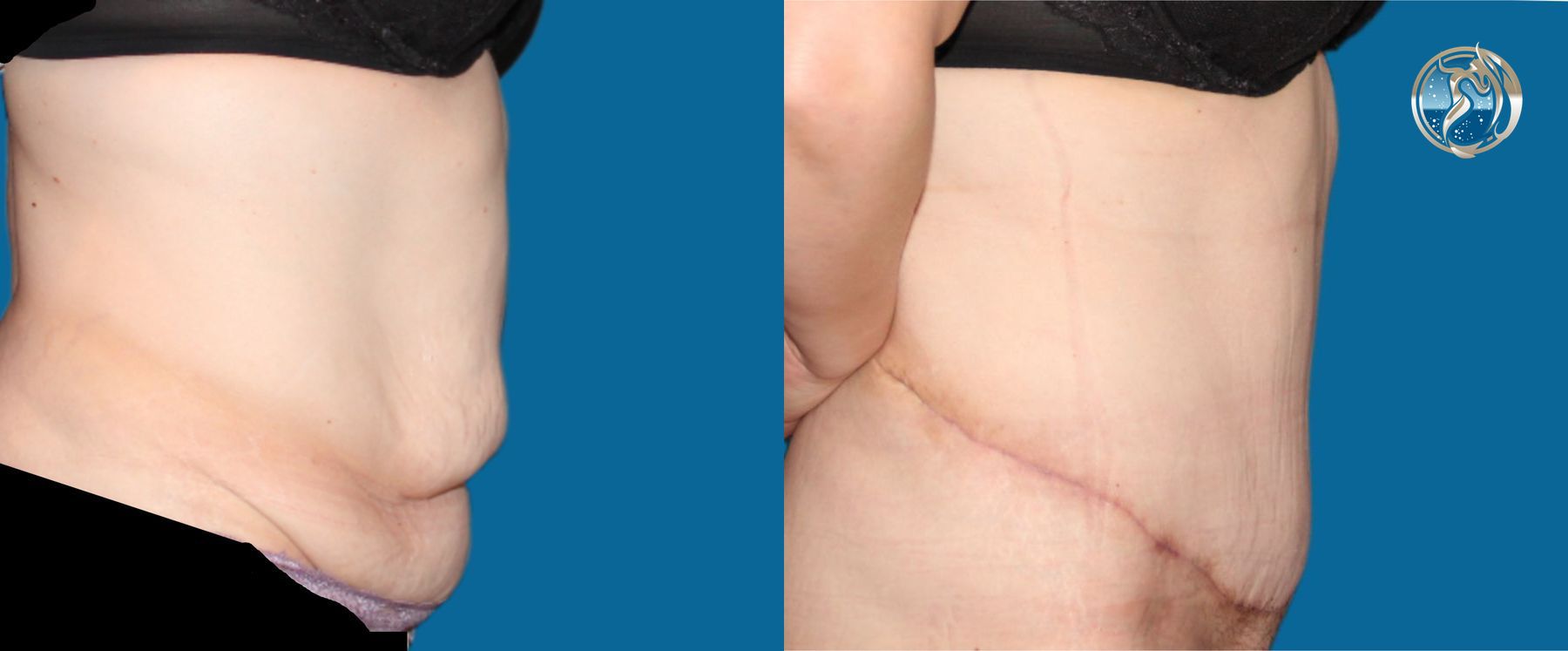 Before and after photo set body contouring by Dr. Orna Fisher in San Mateo, CA - Angle 3