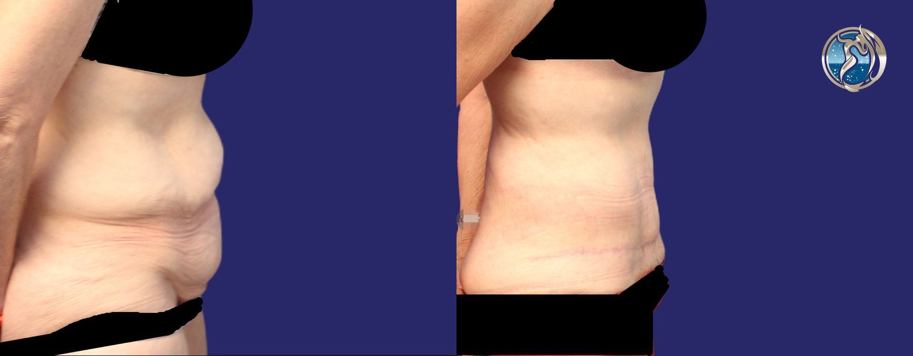 Before and after photo set of body contouring tummy tuck by Dr. Orna Fisher in San Mateo, CA - Angle 3
