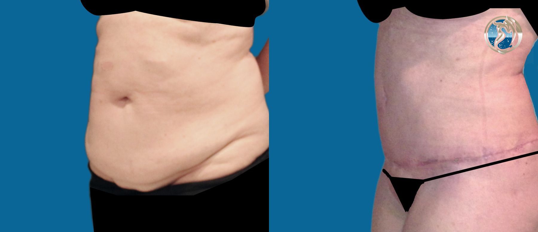 Before and after photo set of extended tummy tuck by Dr. Orna Fisher in San Mateo, CA - Angle 3