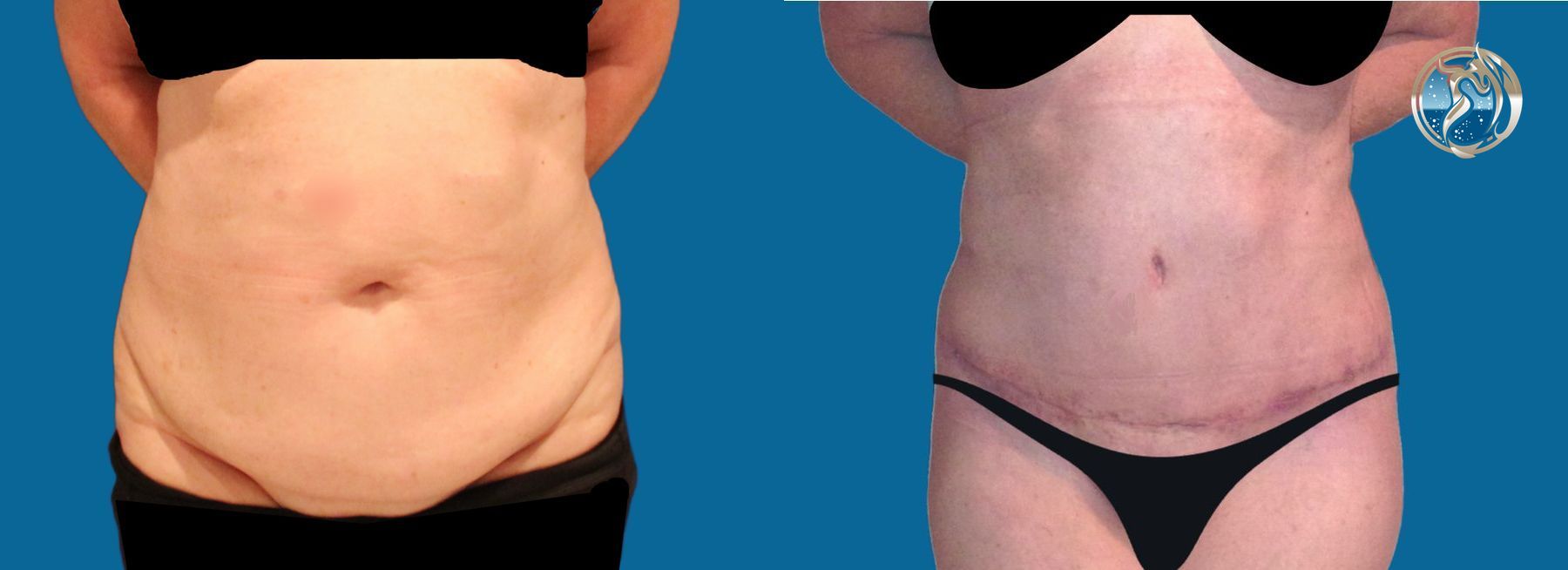 Before and after photo set of extended tummy tuck by Dr. Orna Fisher in San Mateo, CA