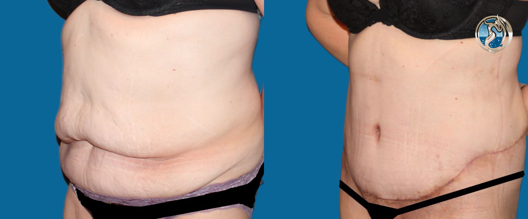Before and after photo set body contouring by Dr. Orna Fisher in San Mateo, CA - Angle 4