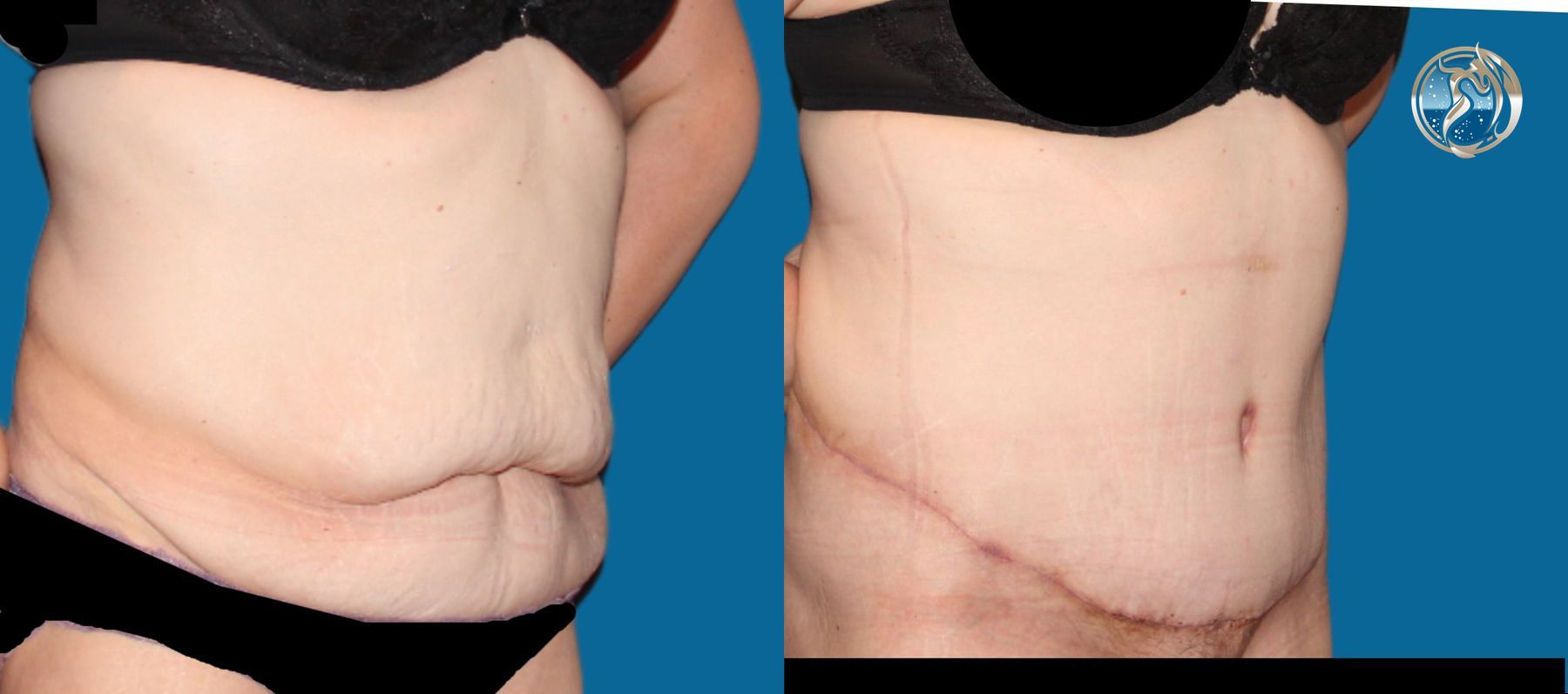 Before and after photo set body contouring by Dr. Orna Fisher in San Mateo, CA - Angle 2