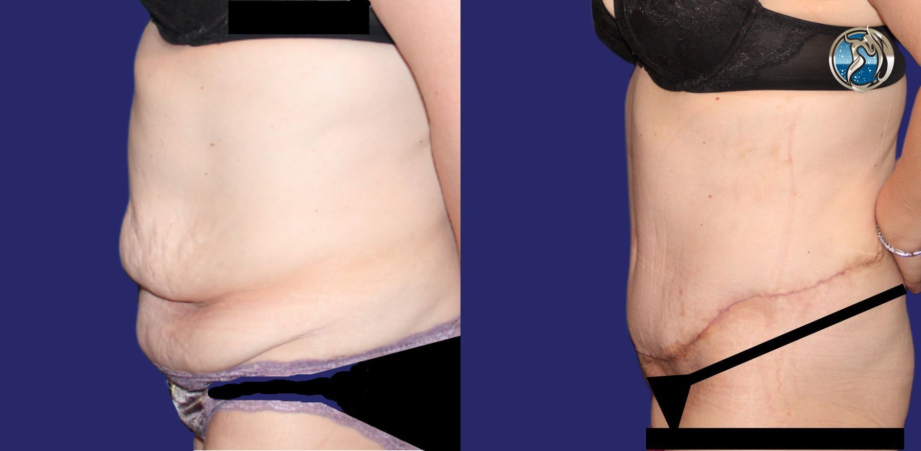 Before and after photo set body contouring by Dr. Orna Fisher in San Mateo, CA - Angle 5
