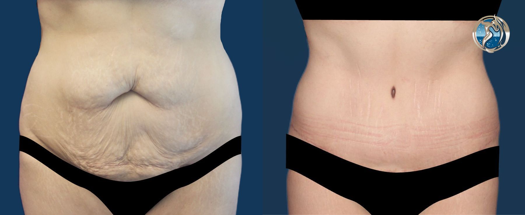 Before and after GLP-1 and Bariatric Contour Restoration case 43751