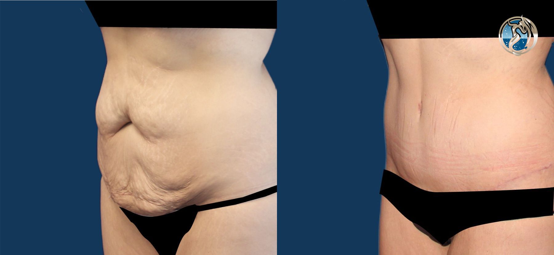 Before and after GLP-1 and Bariatric Contour Restoration case 43751 - Angle 2