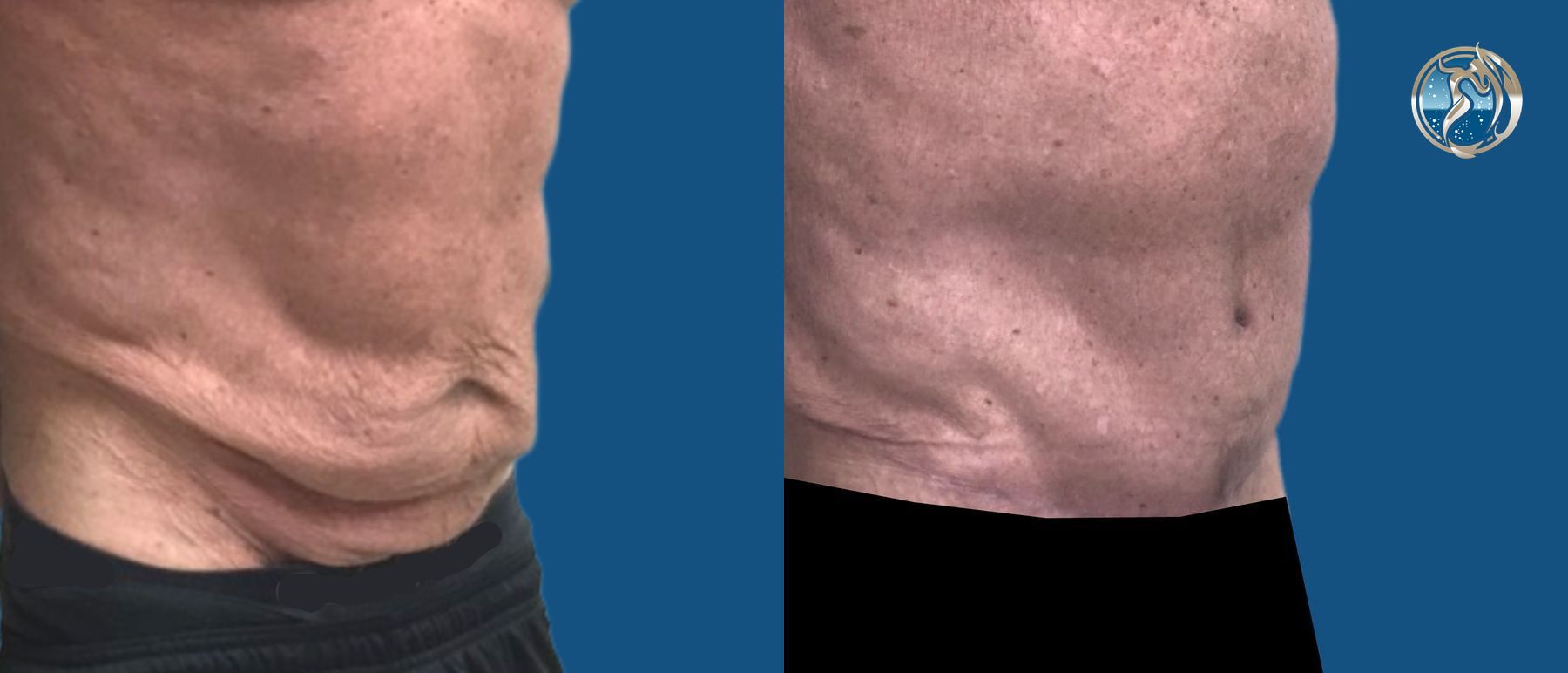 Before and after GLP-1 and Bariatric Contour Restoration case 46072 - Angle 4
