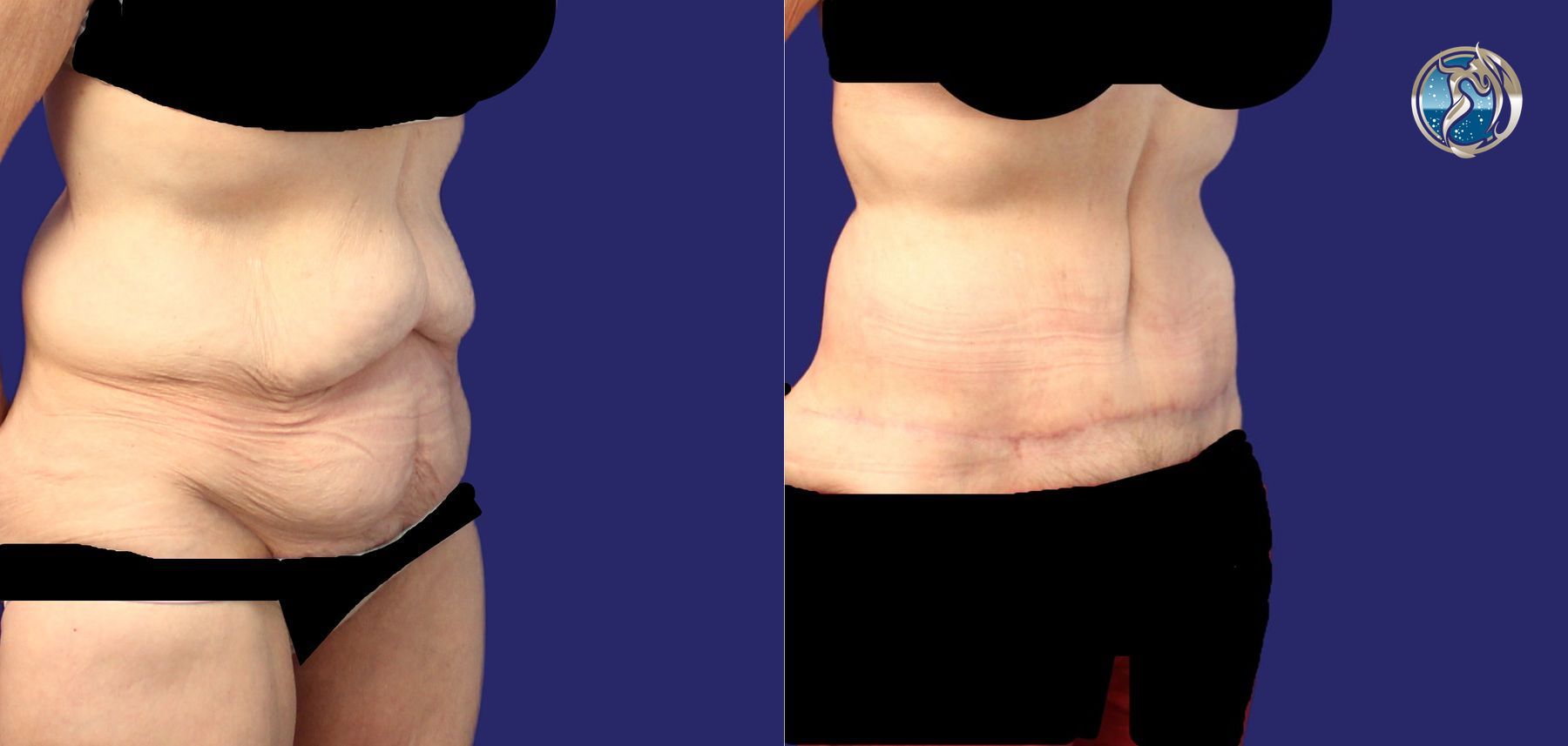 Before and after photo set of body contouring tummy tuck by Dr. Orna Fisher in San Mateo, CA - Angle 2