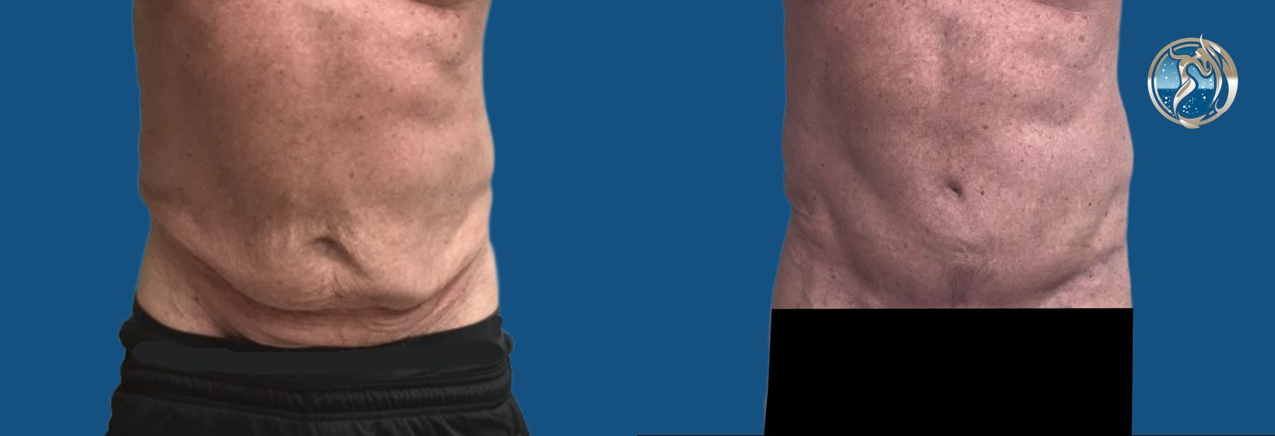 Before and after GLP-1 and Bariatric Contour Restoration case 46072