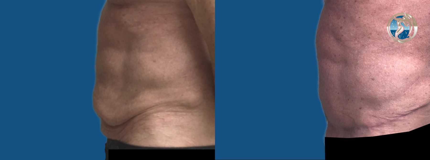 Before and after GLP-1 and Bariatric Contour Restoration case 46072 - Angle 3