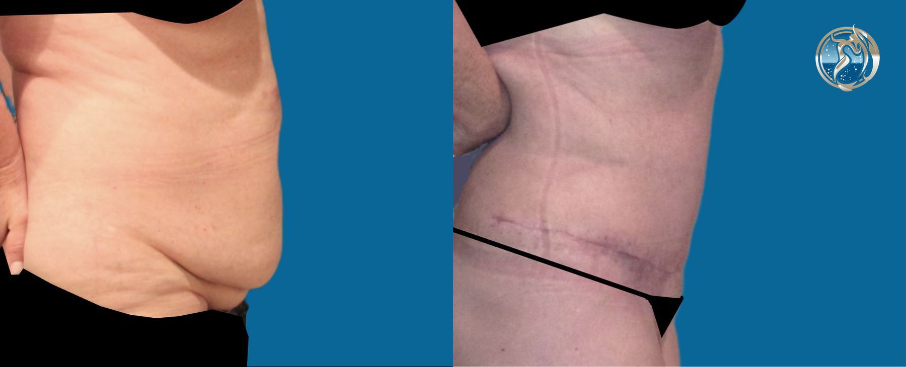 Before and after photo set of extended tummy tuck by Dr. Orna Fisher in San Mateo, CA - Angle 2