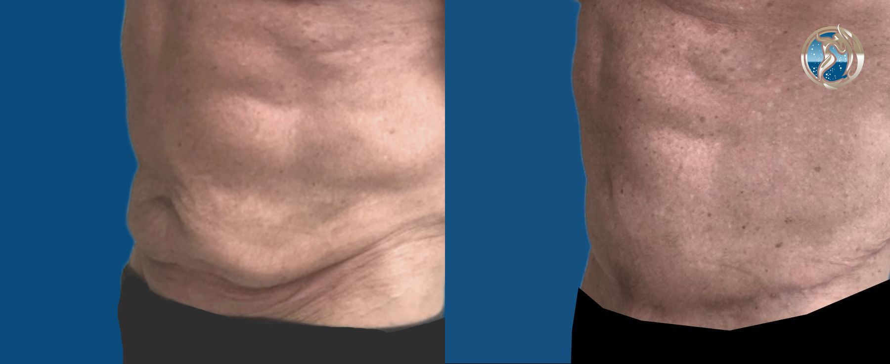 Before and after GLP-1 and Bariatric Contour Restoration case 46072 - Angle 2