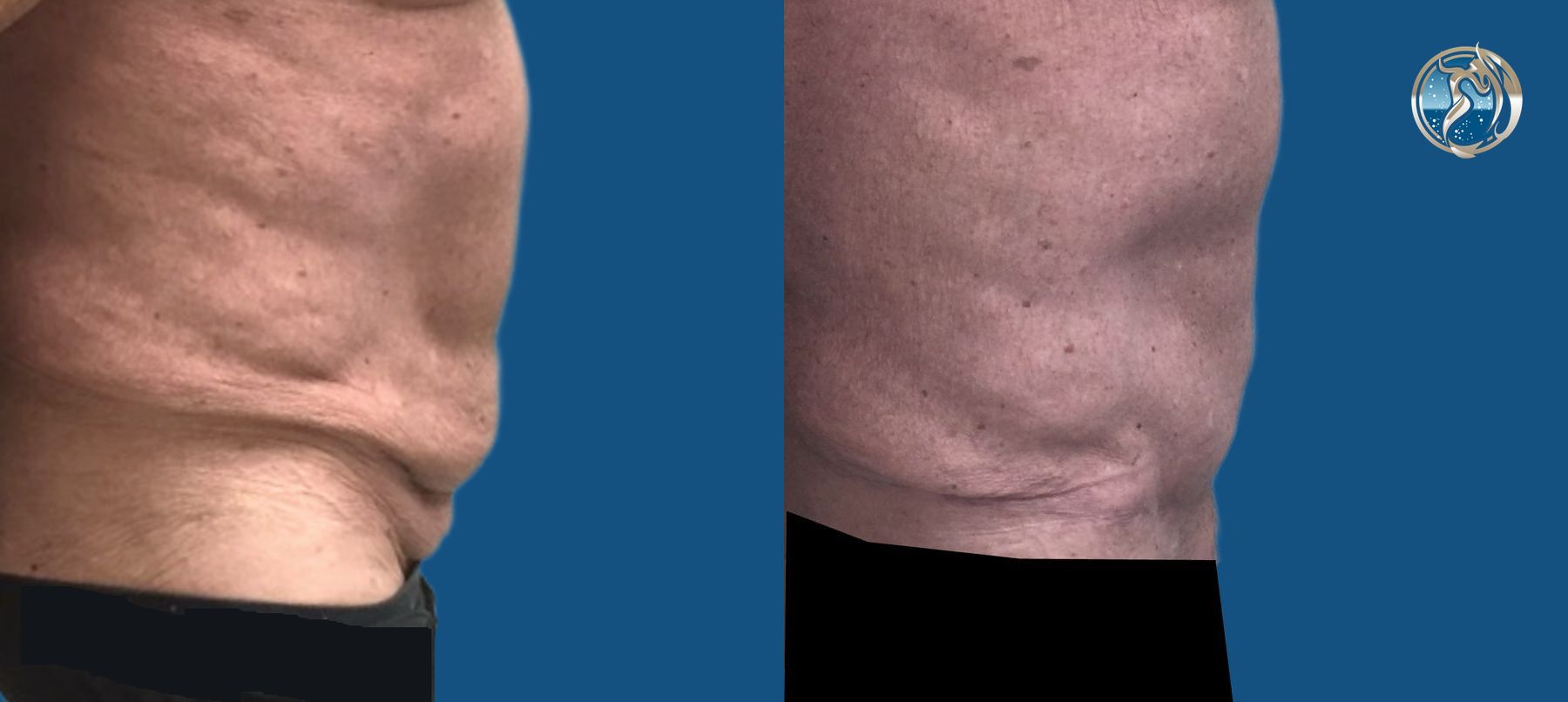 Before and after GLP-1 and Bariatric Contour Restoration case 46072 - Angle 5