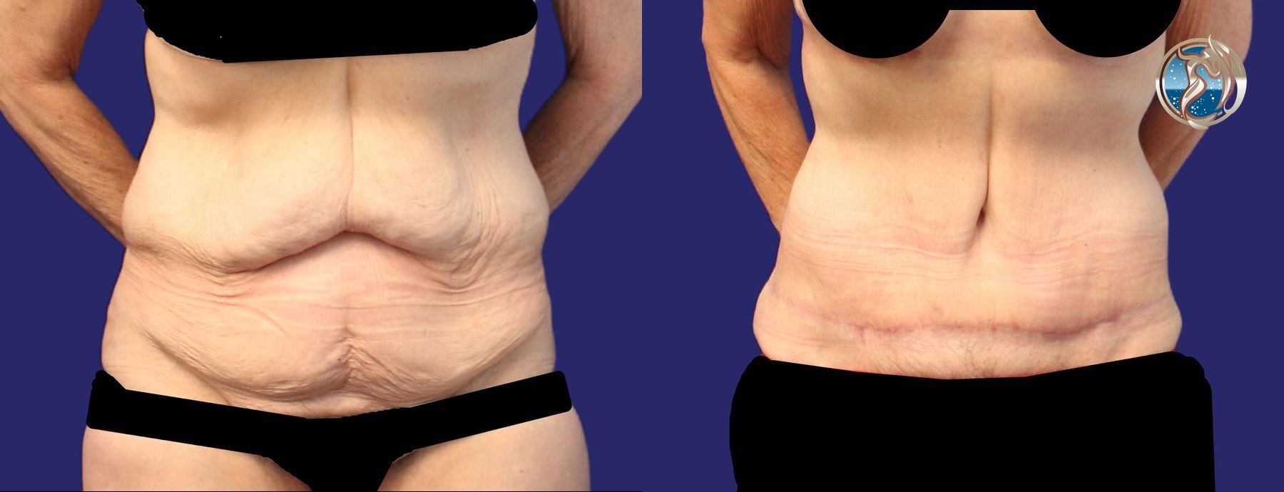 Before and after photo set of body contouring tummy tuck by Dr. Orna Fisher in San Mateo, CA