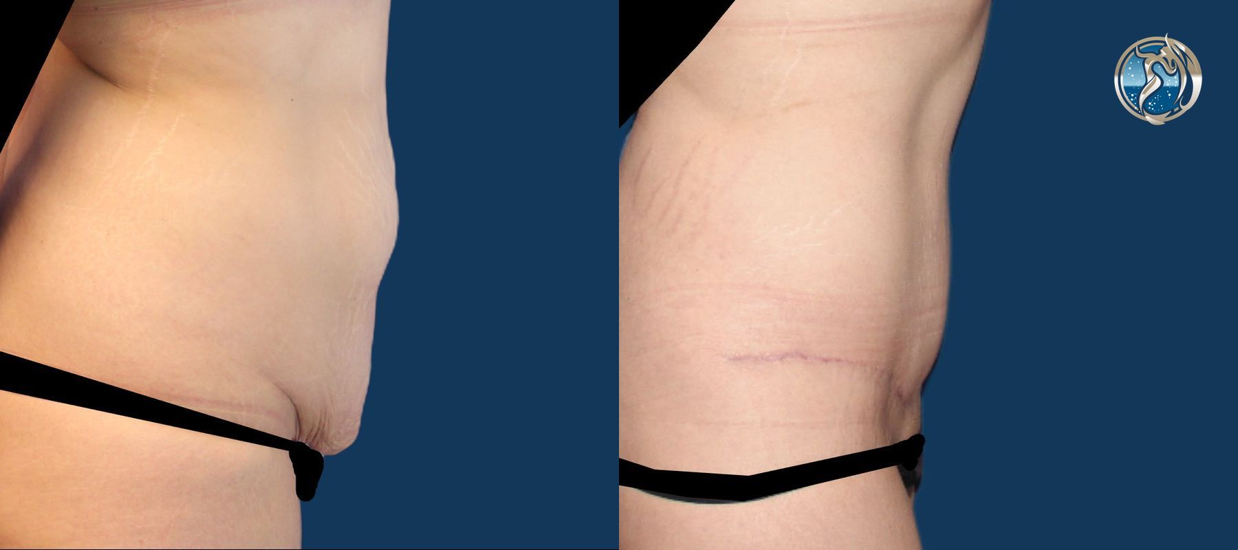 Before and after GLP-1 and Bariatric Contour Restoration case 43751 - Angle 3