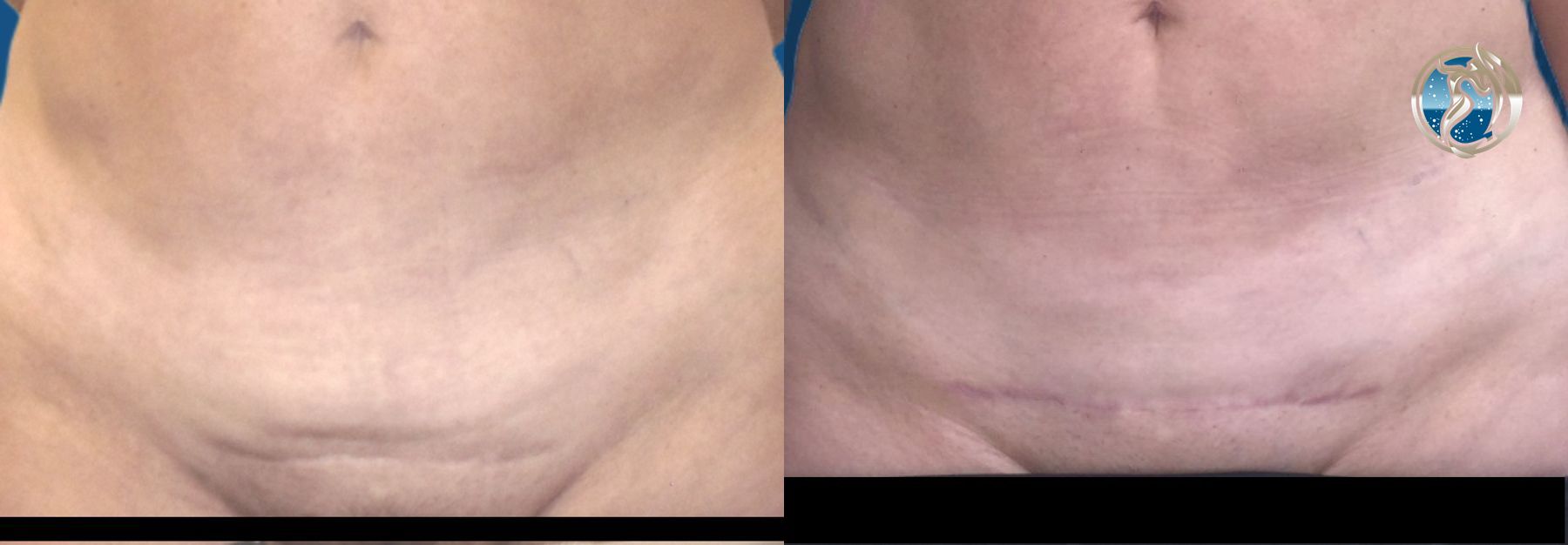 Before and after photo of Monsplasty by Dr. Orna Fisher in San Mateo, CA