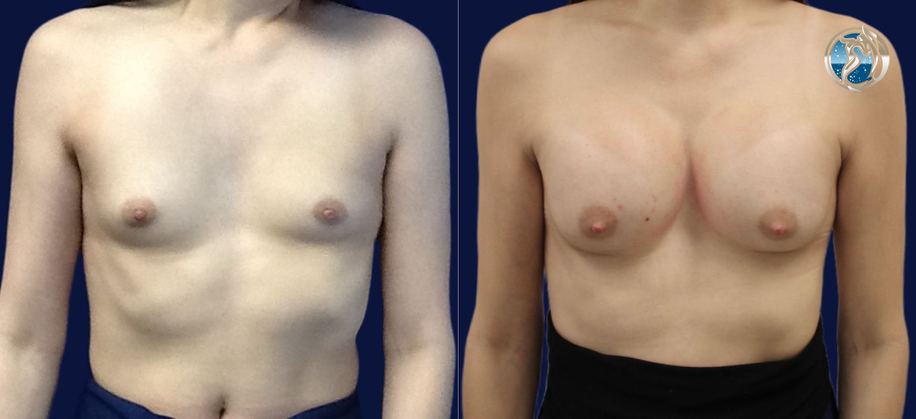 Before and after photo of MTF breast augmentation by Dr. Orna Fisher in San Mateo, CA