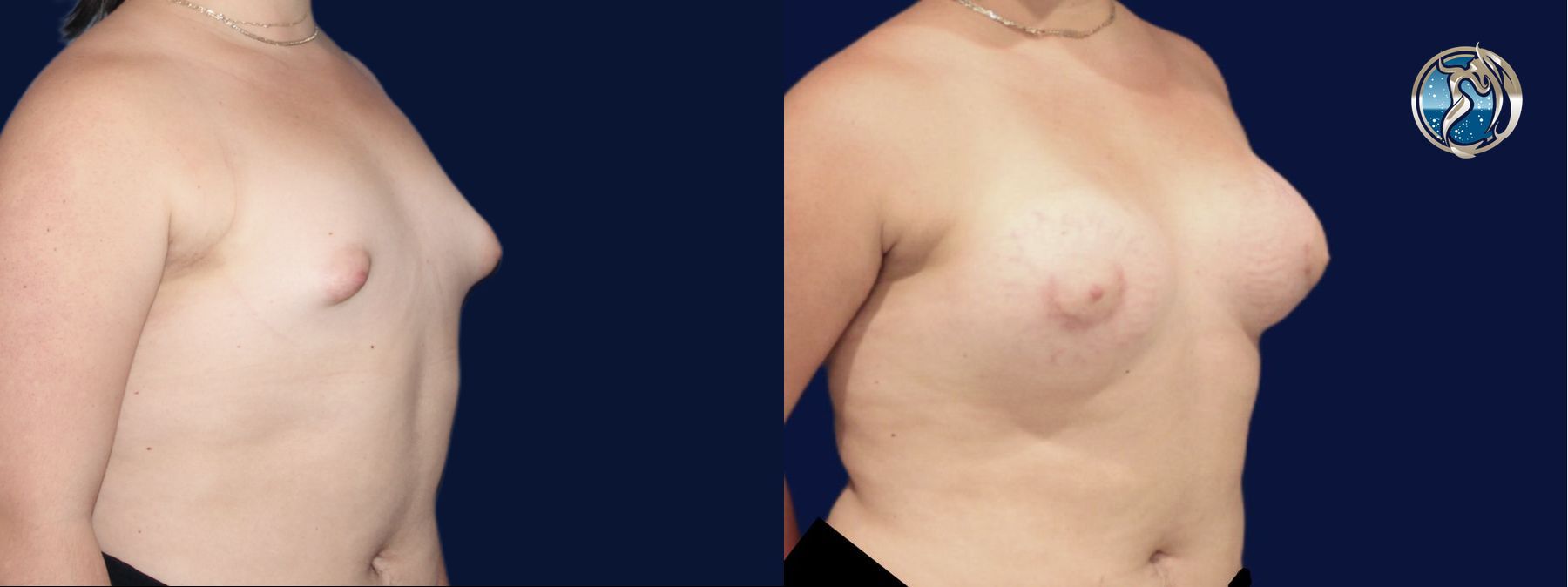 Before and after Transfeminine Breast Augmentation case 45710 - Angle 2