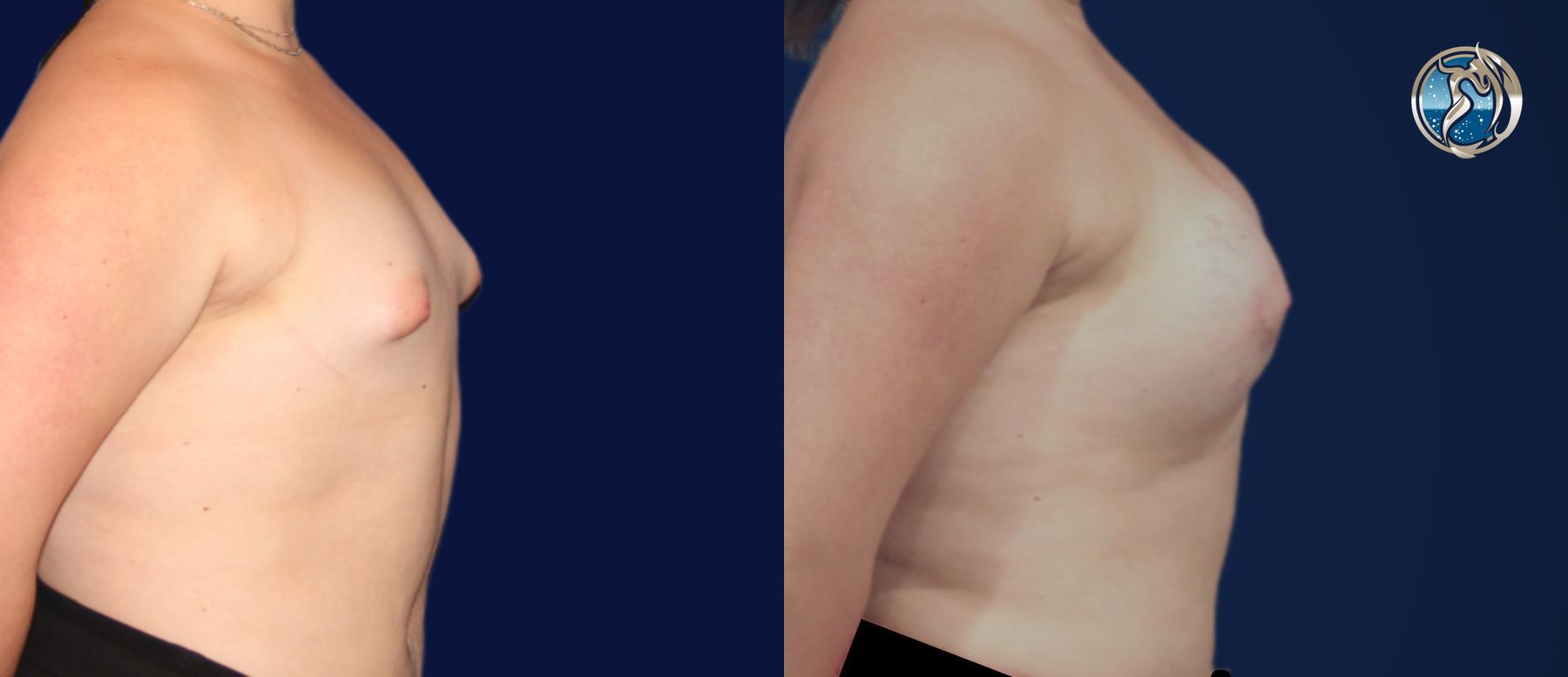 Before and after Transfeminine Breast Augmentation case 45710 - Angle 4
