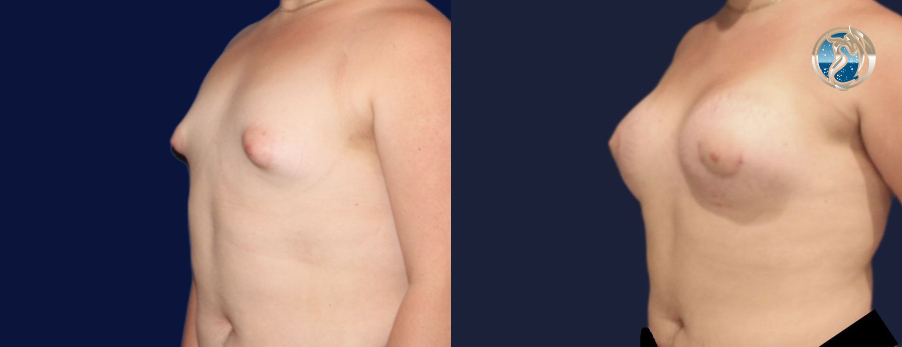 Before and after Transfeminine Breast Augmentation case 45710 - Angle 3