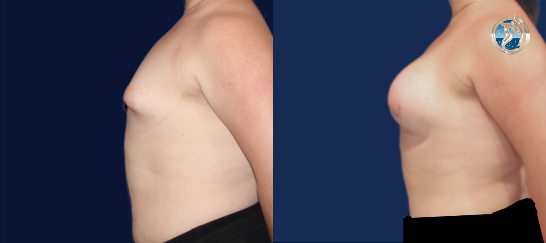 Before and after Transfeminine Breast Augmentation case 45710 - Angle 5
