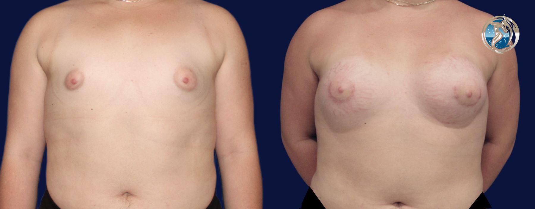 Before and after Transfeminine Breast Augmentation case 45710