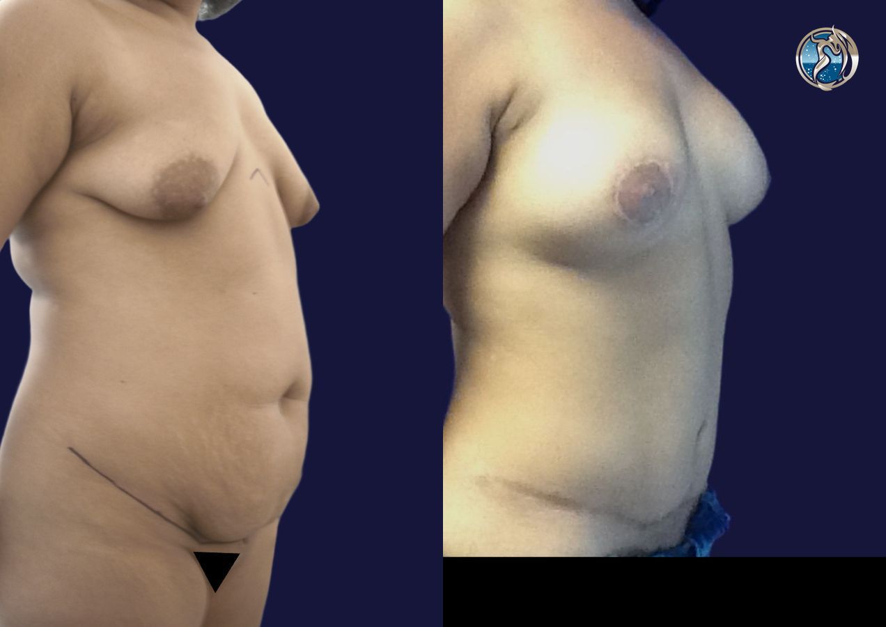 Before and after photo set of Mommy Makeover by Dr. Orna Fisher in San Mateo, CA - Angle 2