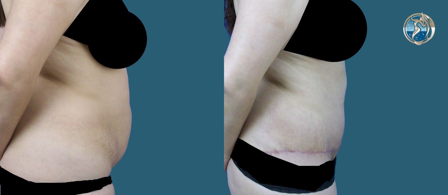 Before and after Liposuction and BodyTite minimally invasive surgical tightening case 43771 - Angle 3