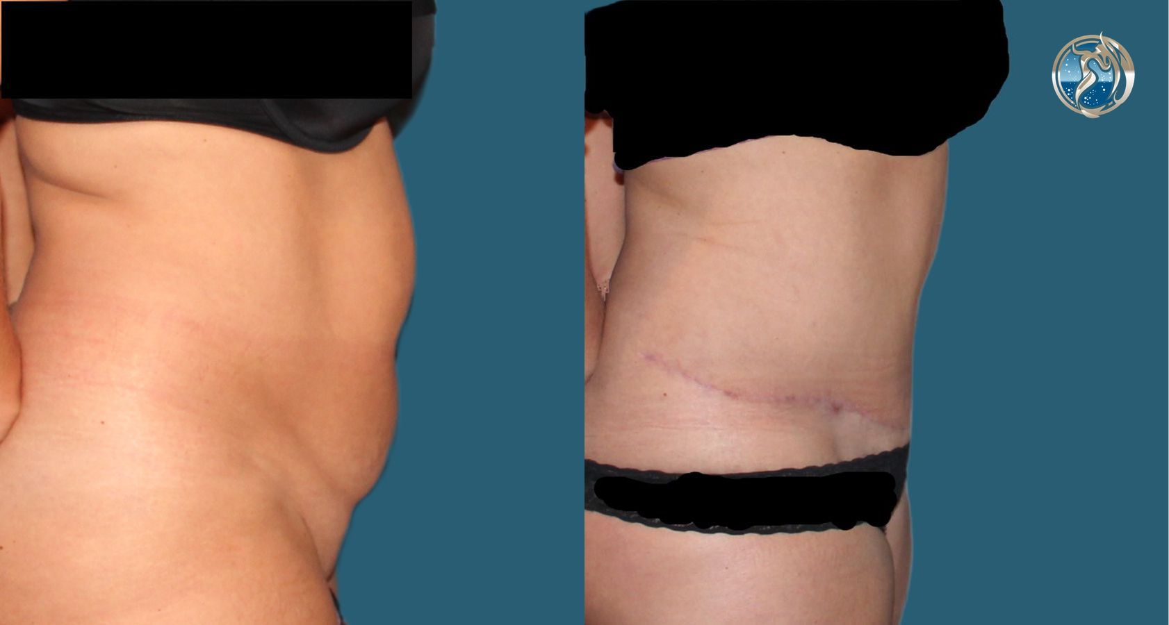 Before and after photo set of tummy tuck with lipo by Dr. Orna Fisher in San Mateo, CA - Angle 5
