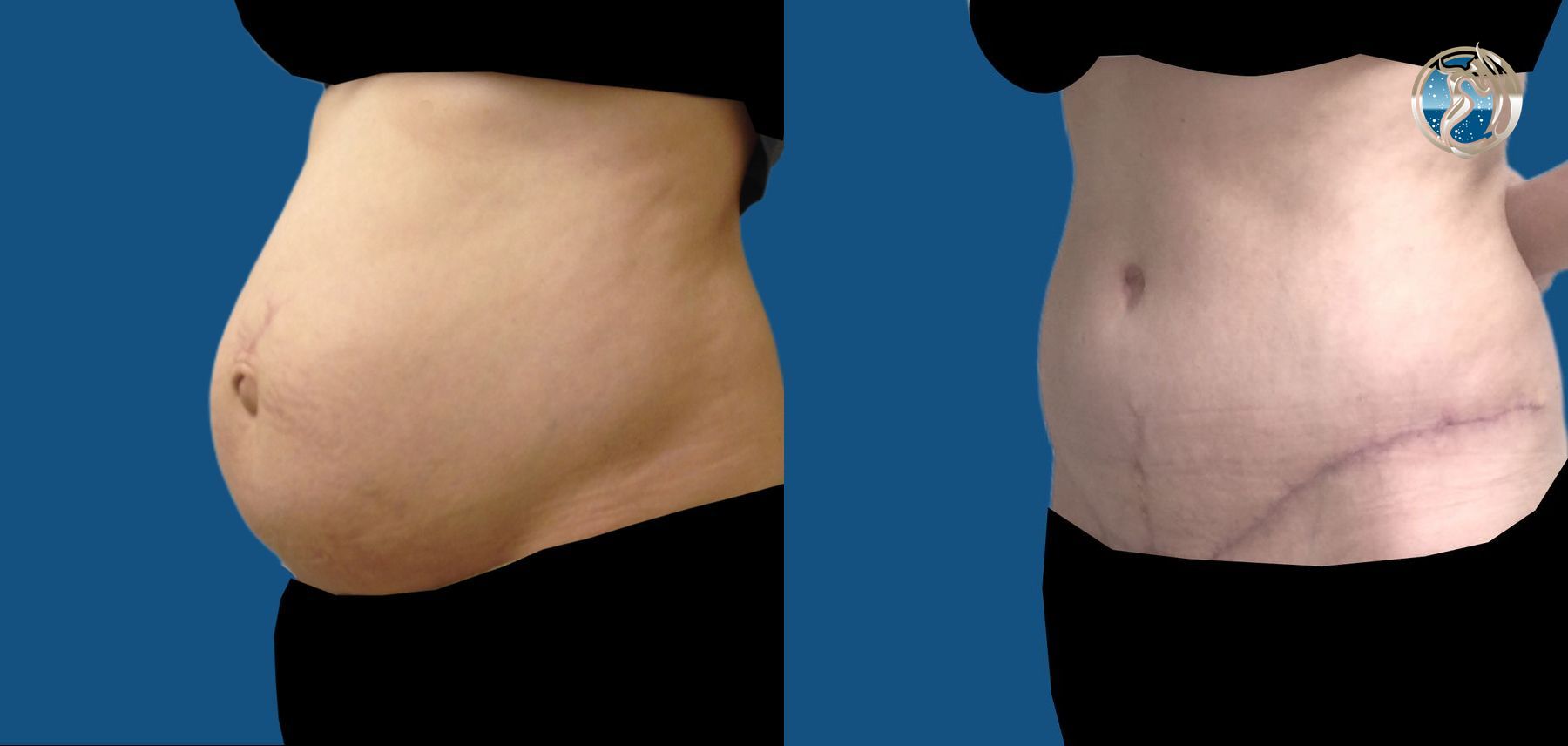 Before and after Tummy Tuck case 46038 - Angle 3