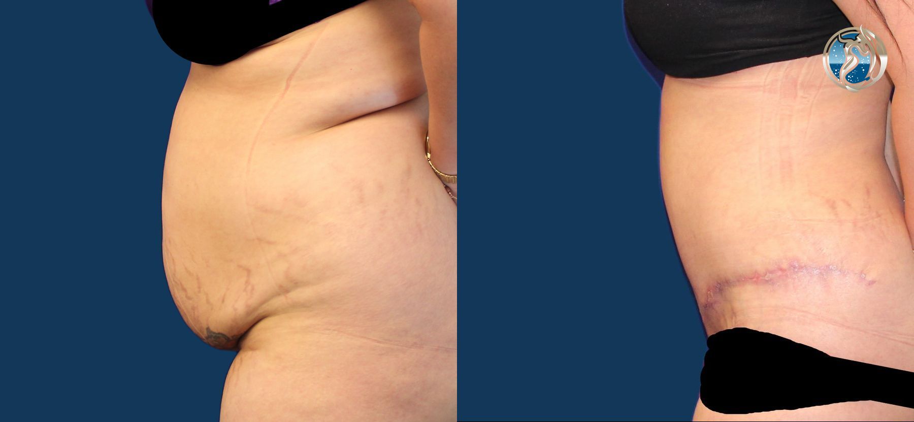 Before and after photo set of Abdominoplasty with lipo by Dr. Orna Fisher in San Mateo, CA - Angle 5