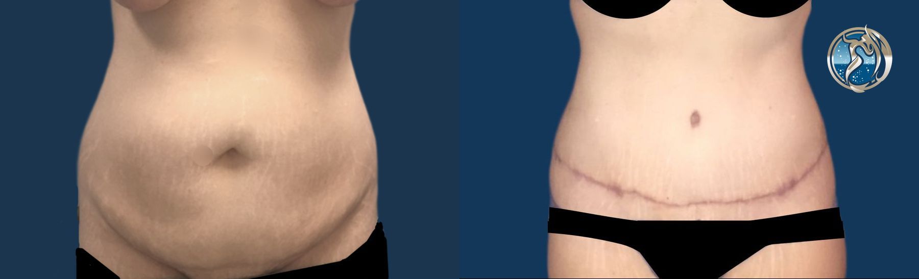 Before and after photo set of body contouring tummy tuck by Dr. Orna Fisher in San Mateo, CA