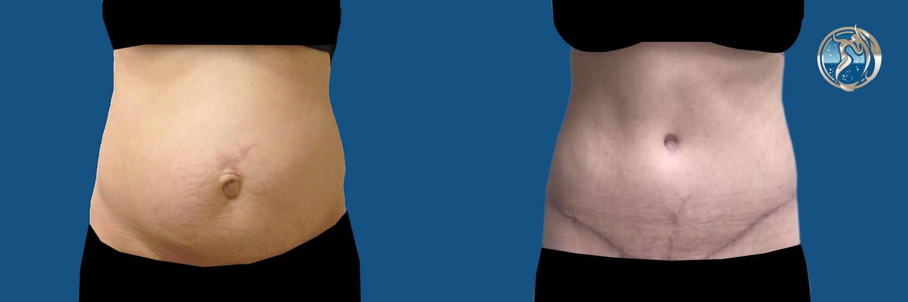 Before and after Tummy Tuck case 46038