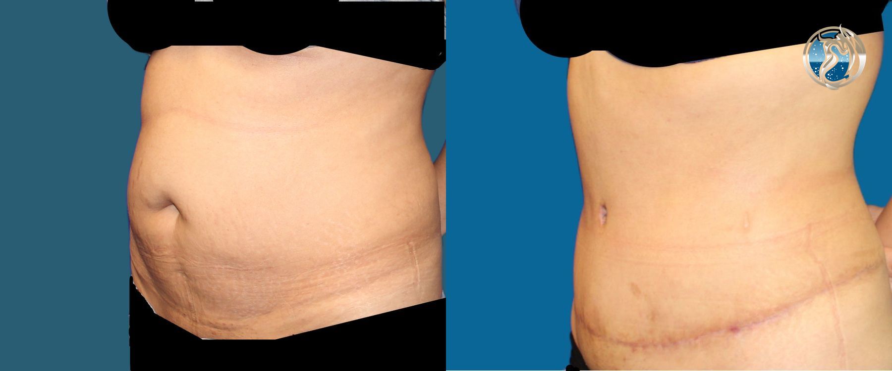 photos of tummy tuck and waist liposuction by Dr. Orna Fisher in San Mateo, CA - Angle 5